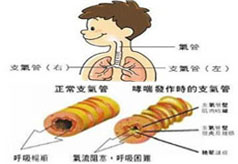 职业性哮喘该如何治疗